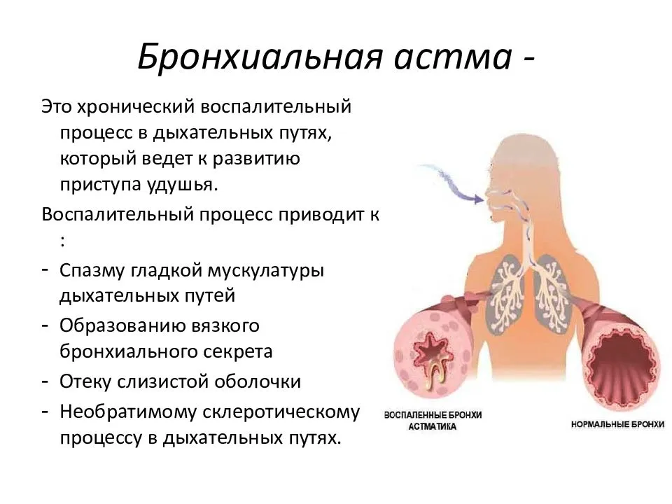 Одышка на вдохе кашель с выделением мокроты. Бронхиальная астма локализация. Причины развития бронхиальной астмы. Заболевания дыхательной системы бронхиальная астма. Факторы вызывающие бронхиальную астму.