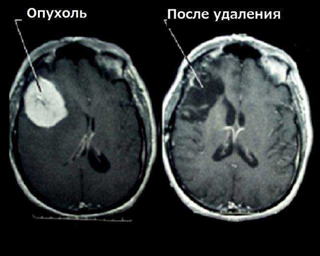 Лечение опухоли головного мозга: удаление с помощью операции и без нее, последствия лечения рака головного мозга