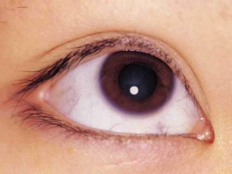 Синдром «сухого глаза»: причины возникновения и диагностика | лечение роговично-конъюнктивального ксероза