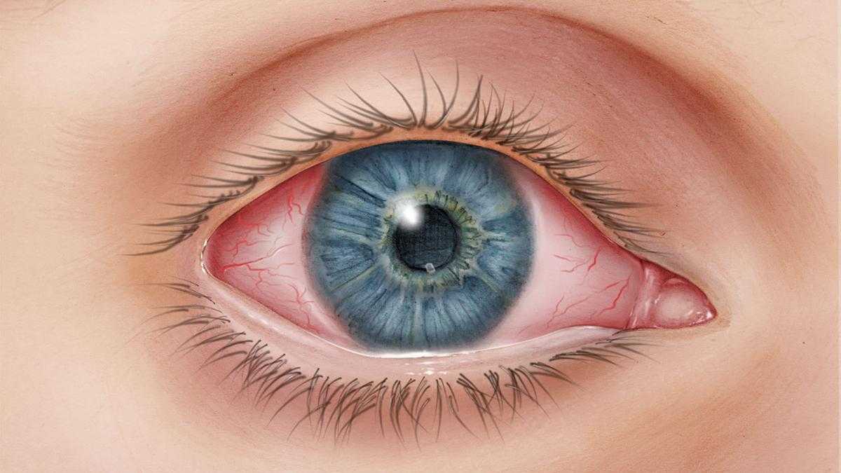 Заболевания роговицы глаза