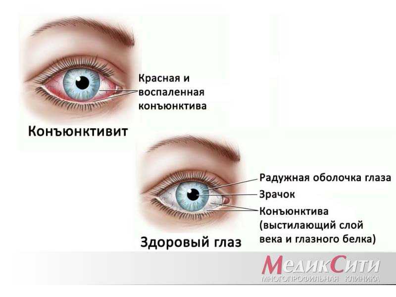 Почему развивается конъюнктивит? какие формы воспаления возможны?
