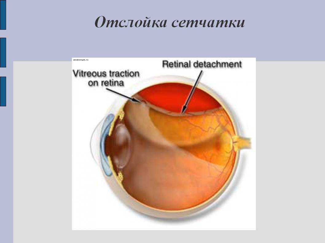 Отслойка сетчатки острота зрения. Отслойка сетчатки катаракта операция. Неопластическая отслойка сетчатки.