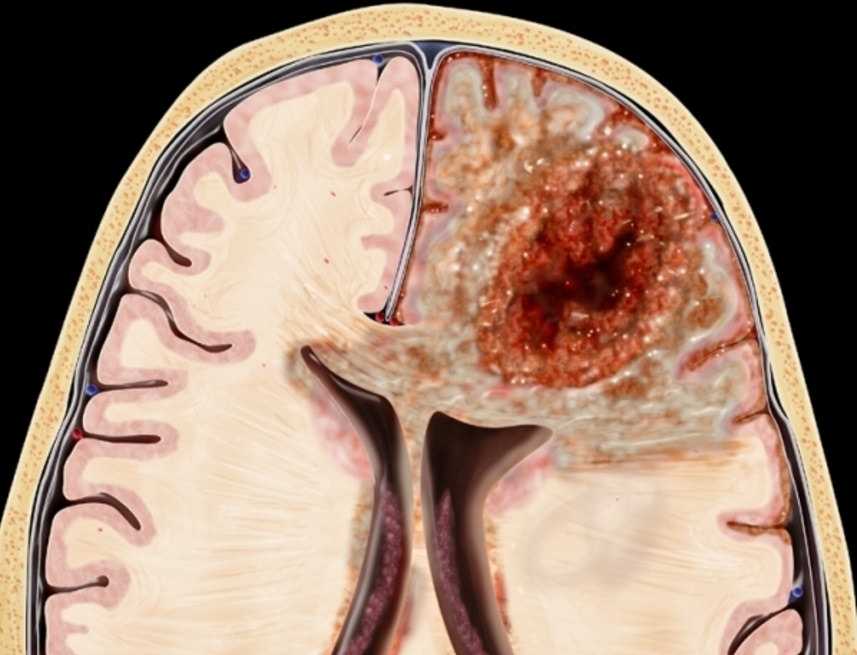 Заболевания головного мозга - симптомы, виды и лечение, диагностика заболеваний головного мозга в клинике expert clinics
