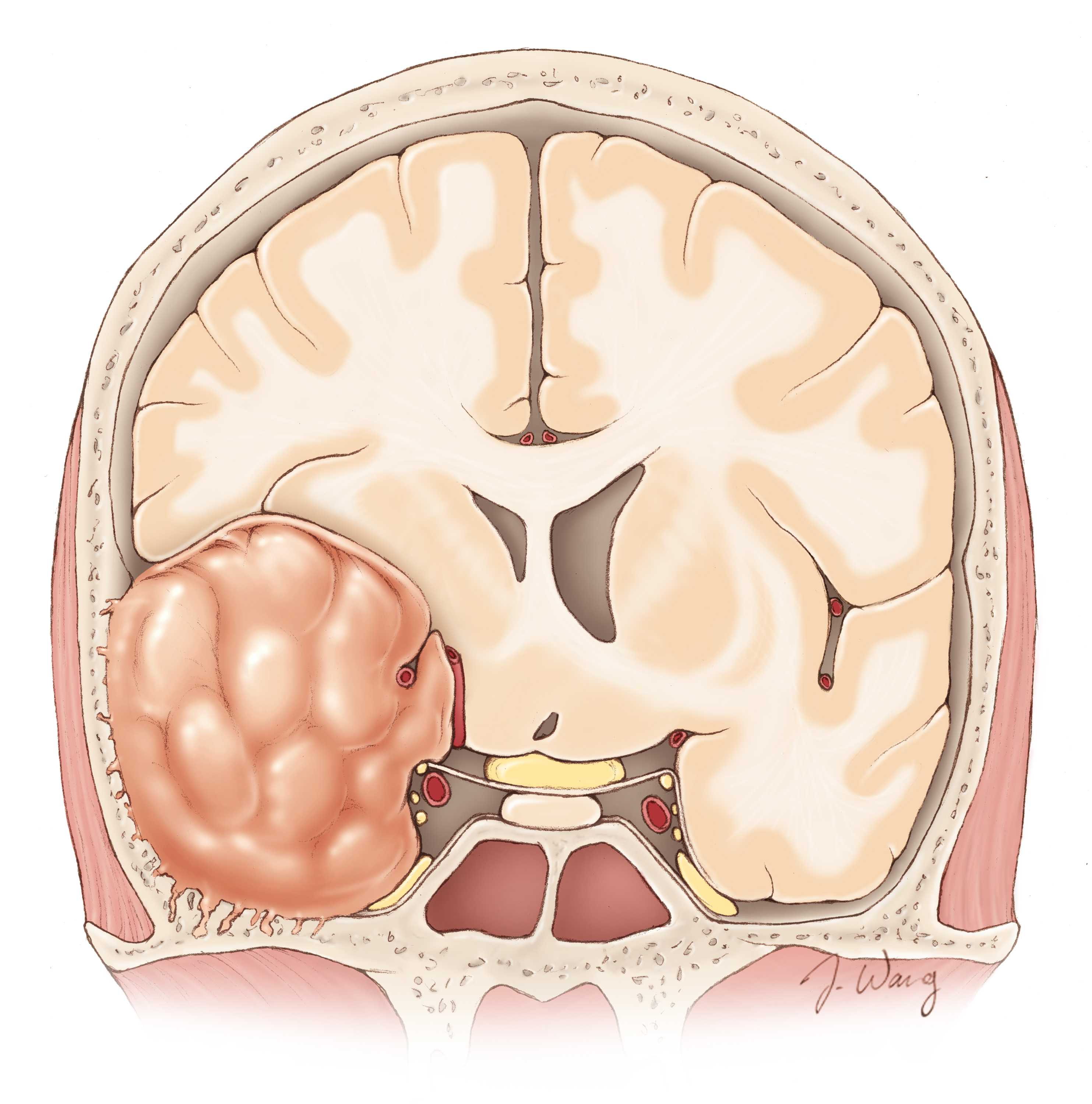 Опухоль головного мозга это. Менингиома доброкачественная. Менингиома кости черепа. Опухоли мозга (менингиома);. Атипическая менингиома.