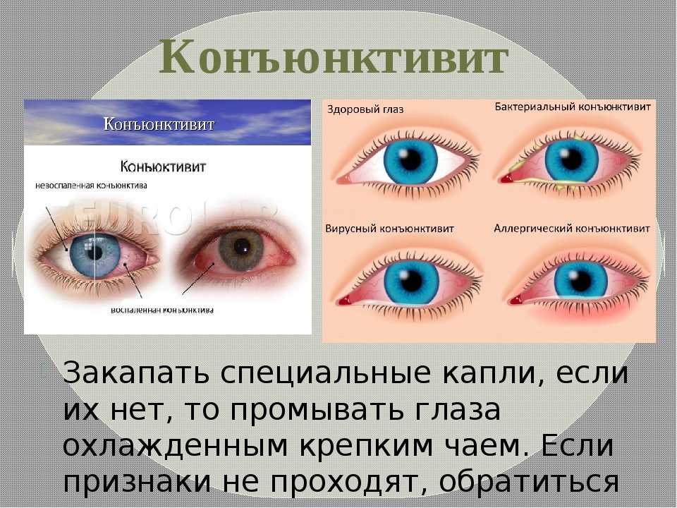 Почему развивается конъюнктивит? какие формы воспаления возможны?