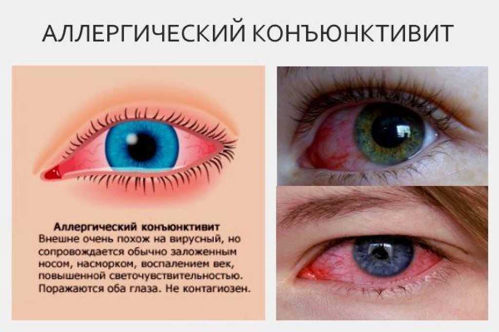 Нервный тик глаза у взрослых: причины и лечение