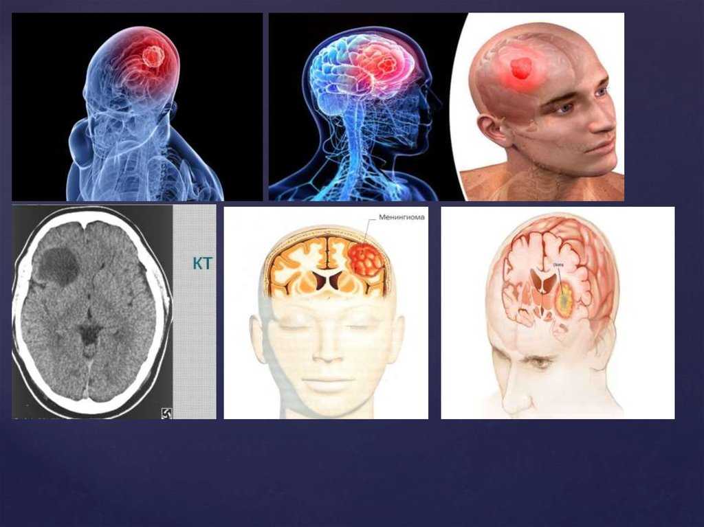 Опухоль головного мозга: симптомы, причины, стадии, диагностика и как лечат рак мозга | клиники «евроонко»