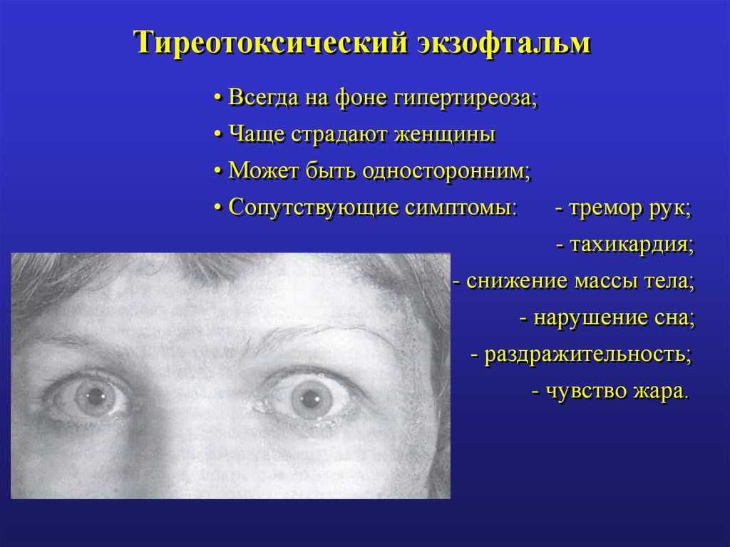 Появился почему появился симптом. Тиреотоксикоз офтальмопатия эндокринная. Базедова болезнь экзофтальм. Тиреотоксический экзофтальм симптомы. Экзофтальм при тиреотоксикозе.